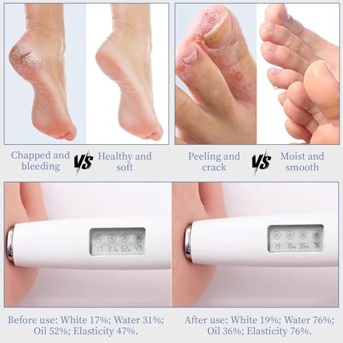 10.1 Oz - Urea Cream 70% plus Salicylic Acid 2% for Dry Cracked Feet, Heels, Knees, Elbows and Hands, Moisturizes, Softens and Removes Calluses Dead Skin