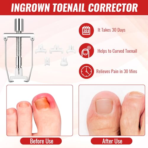 Ingrown Toenail Removal Kit, Ingrown Toenail Relief Tool Kit with Ingrown Toenail Corrector, Ingrown Toenail Drops, Corrector Patch, Toenail Clipper, Nail File Lifter Tools