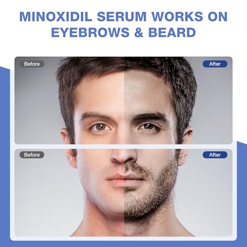 5% Minoxidil for Men Hair Growth Serum - Minoxidil for Women Serum with Biotin for Thicker & Healthier, Topical Minoxidil for Men Restore Fuller Beard
