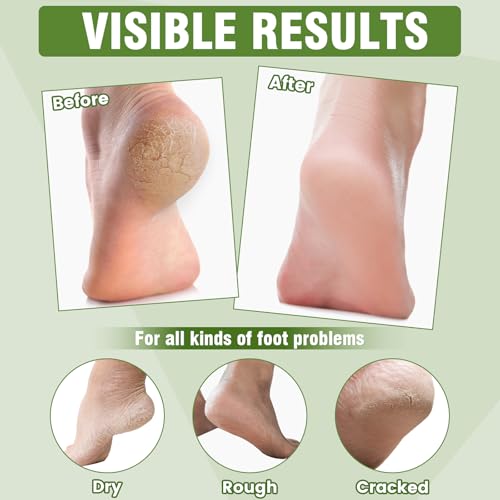 18 Pairs Moisturizing Foot Masks with Shea Butter, Jojoba Oil, Vitamin E & Urea, Intensely Hydrating Foot Mask For Dry Cracked Feet, Moisturizing Socks for Cracked Heel Treatment