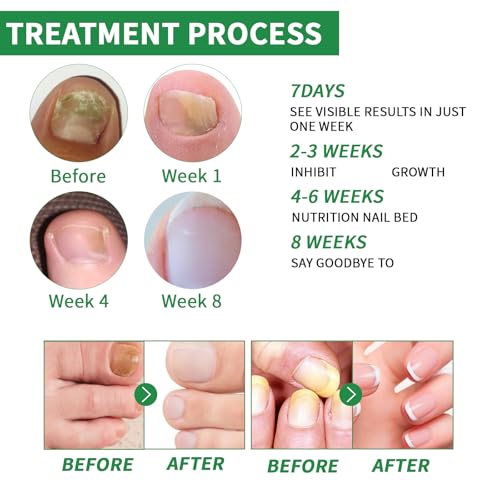 3PCS Ginger Nail Treatment, Ginger Cuticle Care Oil for Nails, Multi-Purpose Nail Repair Nutrient Oil (02)