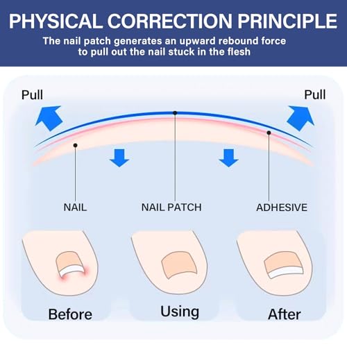 Ingrown Toenail Treatment, 10 packs Titanium Alloy Ingrown Toenail Corrector for All Size Curve Correct Ingrown Toenail, Ingrown Toenail Removal Kit for Straightener of Big Toe