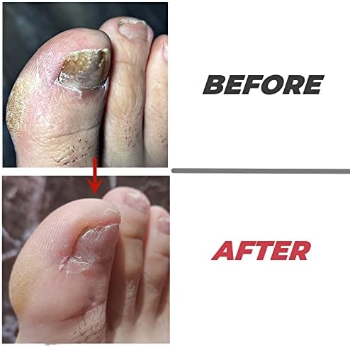 2-Piece Stainless Steel Toenail File for Thick Nails | 4-Sided Design with Non-Slip Grip & Thumb Protector | 7" Durable Metal Nail File for for All, Elderly & Dogs