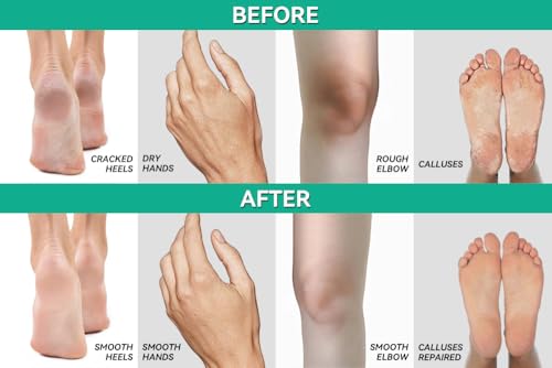 CLEAR 40 Urea Cream 40 Percent for Feet Maximum Strength (4oz) | Softens Cracked Heels & Dry Skin Urea Cream 40 Percent - Tea Tree & Coconut Oil | Callus & Corn Treatment | Made in USA