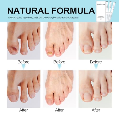 25% Undecylenic Acid, Twist Pen Activator-Suitable for toenails Broken,Discolored & Damaged Nail-3 Pack