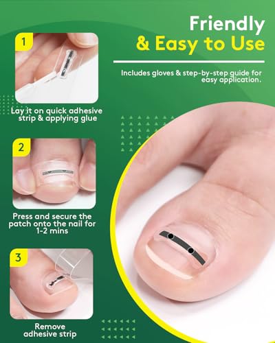 Ingrown Toenail Treatment Kit - Titanium Alloy Nail Corrector Tools, Quick Relief & Long-term Correction Patch for Ingrown Nails, Solution for Curved Toenail Repair & Removal (0.51/0.59/0.67/0.79in)
