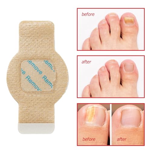 2Pack Fungal Nail Patches, Nail Fungus Patches for Toenail, Fingernail Fungus Treatment,Overnight Toe Nail Treatments for Damaged Nails Ingrown Toenail Foot Nails Repair and Care