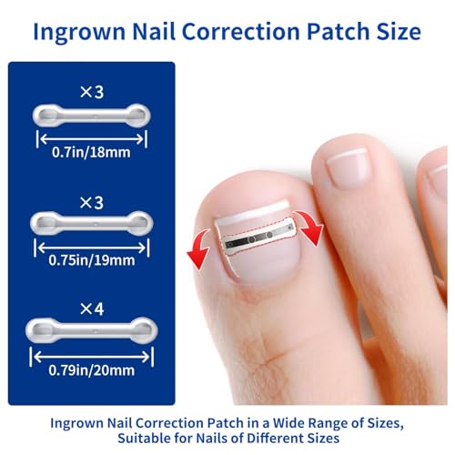 Ingrown Toenail Treatment, 10 packs Titanium Alloy Ingrown Toenail Corrector for all size foot, Ingrown Toenail Removal Kit for Curved Nail Repair, at Home Nail Kit Tools-Blue2