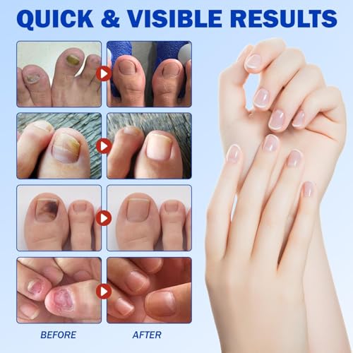 42pcs Toenail Fungus Treatment Extra Strength,Nail Patches for Nail Treatment Overnight,Nail Repair for Damaged Nails Care