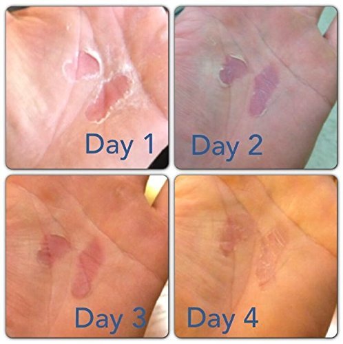 Hand Repair Balm for Dry Cracked Hands, Hand Salve for Gymnastics and Rock Climbers, Rip Fix Climbing Salve for Men and Women, Premium Gymnast Balm for Hardworking Hands, Classic 1.34 oz Tin