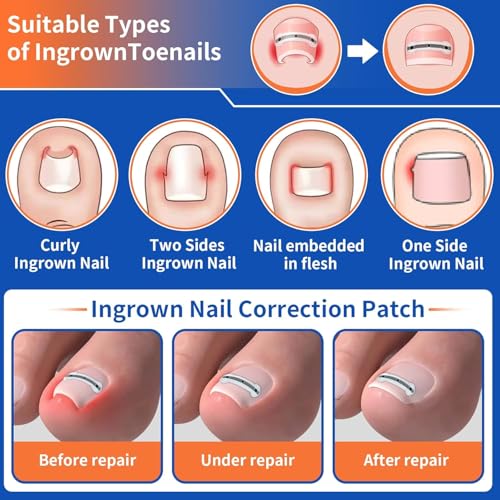 Ingrown Toenail Treatment Kit Titanium Alloy for Quick Relief - 5 Multi-Sizes, Nails Corrector Tool & Remover Strips - Ingrown Toe Nail Relief, Home Use - Men, Women and Kids