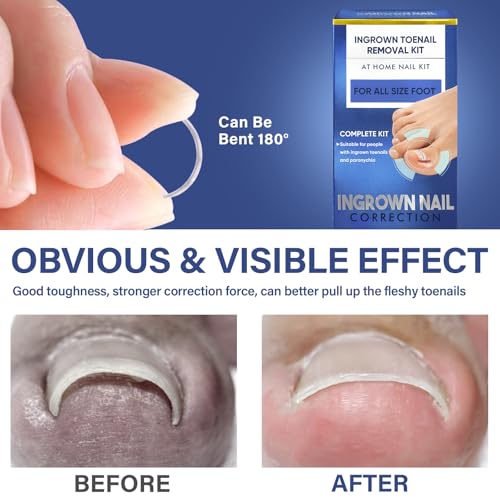 Ingrown Toenail Treatment, 10 packs Titanium Alloy Ingrown Toenail Corrector for All Size Curve Correct Ingrown Toenail, Ingrown Toenail Removal Kit for Straightener of Big Toe