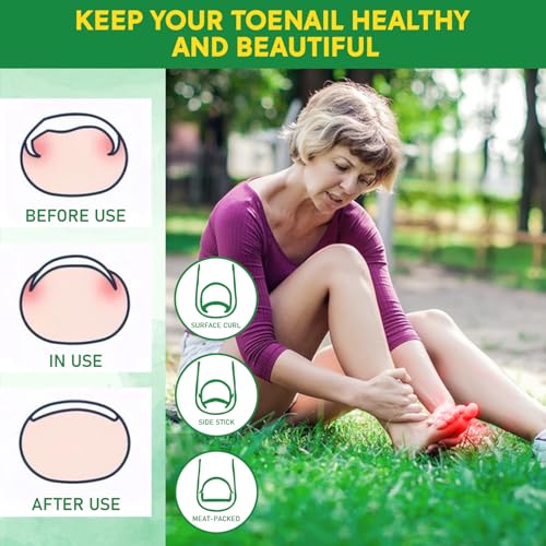 Ingrown Toenail Tools Kit, Ingrown Toenail Treatment, Stainless Steel Ingrown Toenail Removal Kit, Ingrown Toenail Corrector, Corrector Patch, Toenail Clipper, Nail File Lifter Pedicure Tool
