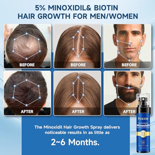 5% Minoxidil for Men and Women Hair Growth, Minoxidil Spray For Beard Growth Serum, Combat Hair Thinning and Loss, Strengthen Regrowth Treatment 3.38 Fl Oz