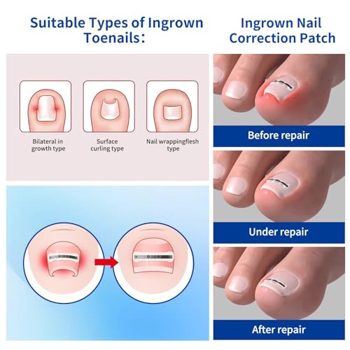 Ingrown Toenail Treatment, 10 packs Titanium Alloy Ingrown Toenail Corrector for all size foot, Ingrown Toenail Removal Kit for Curved Nail Repair, at Home Nail Kit Tools-Blue2