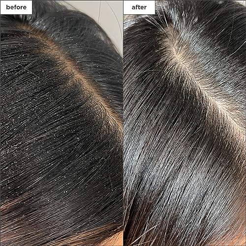 Briogeo Scalp Revival Charcoal + Tea Tree Buildup Detox Spray, Dry Scalp Pre-Wash Treatment for Dry Scalp & Itchy Scalp, Build Up, Detox Spray, Unclog Hair Follicles, Vegan, Cruelty-Free, 4 fl oz