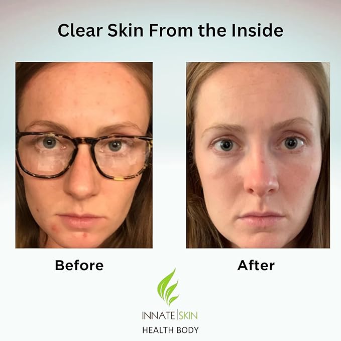 Clear Skin Acne Vitamin System | 20 Antioxidants, Botanicals & Minerals | 60 Count Pack of 4