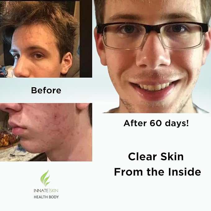 Clear Skin Acne Vitamin System | 20 Antioxidants, Botanicals & Minerals | 60 Count Pack of 4